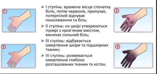Перша допомога при обмороженні Перша допомога при обмороженні